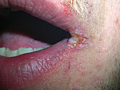 Angular cheilitis