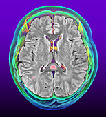 Multisystem inflammatory syndrome, MRI and 3D CT scans