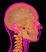 Bones of the skull and neck, CT scan