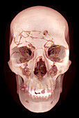 Skull fractures, CT scan