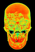 Face and skull fractures, CT scan