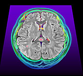 Multisystem inflammatory syndrome, MRI and 3D CT scans