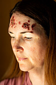 Basal cell carcinoma on a patient's forehead