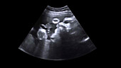 Foetal face, ultrasound scan