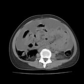 Ascites, CT scan