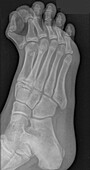 Extra toe, X-ray