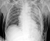 Subcutaneous emphysema, X-ray