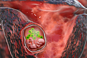 Transplacental transmission of Cytomegalovirus, illustration