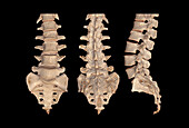 Spinal fracture, 3D CT scans