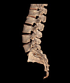 Spinal fracture, 3D CT scan