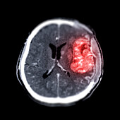 Brain after brain tumor surgery, CT scan