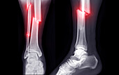 Broken leg, X-rays