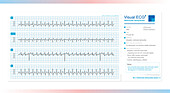 Atrioventricular dissociation, illustration