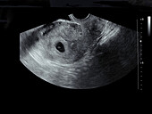 Embryo at six weeks, ultrasound scan