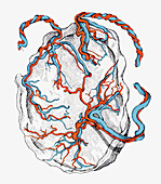Triplet placenta, illustration