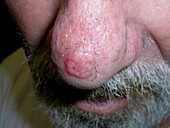 Nodular basal cell carcinoma