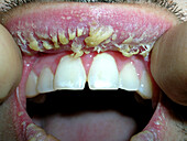 Actinic cheilitis