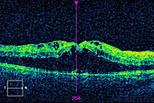 Diabetic macular oedema, OCT scan