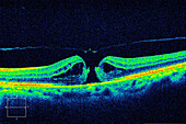 Lamellar macular hole, OCT scan