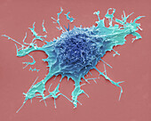 Lymphoma cancer cell, SEM