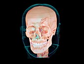 Fractured skull, 3D CT scan