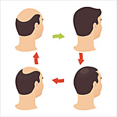 Hair loss, conceptual illustration