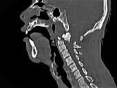 Dislocated neck bones, CT scan
