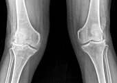 Knee osteoarthritis, X-ray