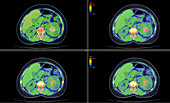 Kidney stone, CT scans