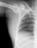 Dislocated shoulder, X-ray