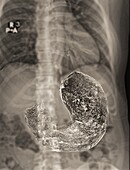 Healthy stomach, barium X-ray