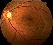 Temporal epiretinal membranes, fundoscopy