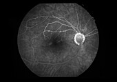 Hemispheric retinal artery occlusion, angiogram
