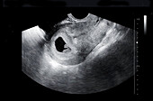 Embryo at seven weeks, ultrasound scan