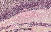 Aorta aneurysm elastic stain, light micrograph