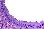 Breast apocrine metaplasia, light micrograph