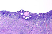Uterus endometrium with atrophy, light micrograph