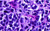 Bladder cancer cells with mitoses, light micrograph