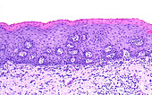 Cervix prolapse, light micrograph