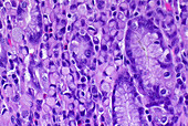 Stomach adenocarcinoma cells, light micrograph