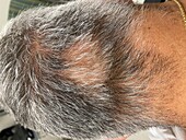 Alopecia areata