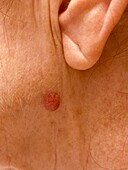 Basal cell carcinoma