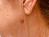 Basal cell carcinoma