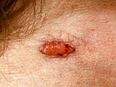 Nodular basal cell carcinoma