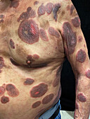 Cutaneous T-cell lymphoma