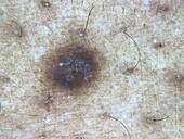 Dermatofibroma, dermoscopy