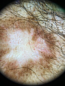 Discoid lupus erythematosus, dermoscopy