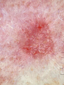 Basal cell carcinoma, dermoscopy