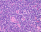 Mantle cell lymphoma, light micrograph
