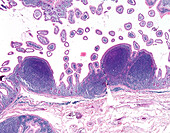 Mantle cell lymphoma, light micrograph